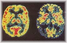 Brain on Alzheimers