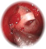 Sinus Cavity > Exploding Head View